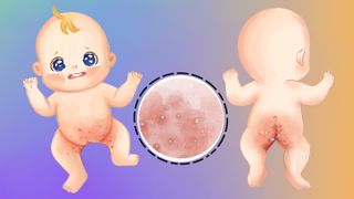 Illustration einer schweren Windeldermatitis mit Pilzbefall – scharf begrenzte Rötung und Pusteln