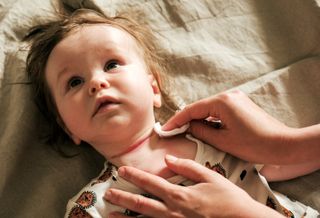 Gereizte und trockene Halsfalte eines Babys