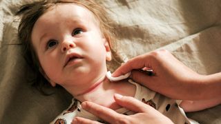 Gereizte und trockene Halsfalte eines Babys